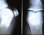膝のレントゲン